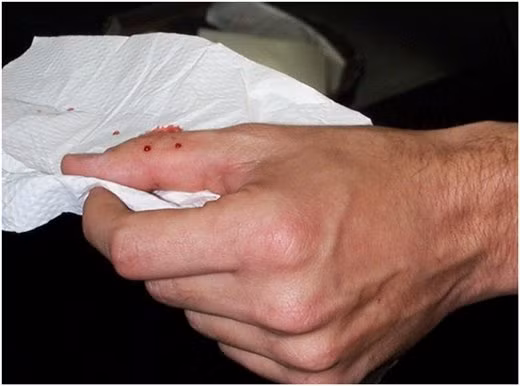 7. Lá phèn đen dùng chữa rắn độc cắn. Chú ý: Tránh nhầm cây phèn đen với cây phèn trắng có lá màu hơi vàng, quả màu trắng. Ảnh: KhoaHoc.tv. (Thông tin trong bài chỉ mang tính tham khảo, trước khi sử dụng bài thuốc, bạn vui lòng hỏi ý kiến bác sĩ).