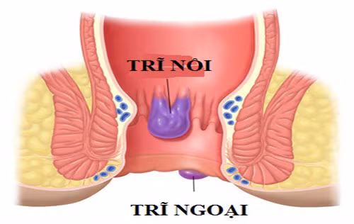 3. Hỗ trợ chữa trĩ (giai đoạn 1): Lá phèn đen 1 nắm, lá trắc bách diệp 1 nắm, lá huyết dụ 5 lá. Tất cả rửa sạch, thái nhỏ, sao vàng hạ thổ. Cho vào ấm, đổ 800ml nước, sắc đặc còn 200ml nước. Uống ngày 150ml, còn lại đổ thêm nước đun kỹ dùng để rửa ngâm trĩ ngày 1 – 2 lần. Mỗi liệu trình từ 5-10 ngày. Ảnh: m.dakhoa.phongkhamthekymoi.com.
