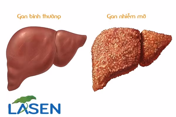 Chữa gan nhiễm mỡ: Mỗi ngày ăn 5-7 quả táo mèo, hoặc dùng 10-15 quả sắc nước uống. Chữa cao huyết áp, mỡ máu cao: Táo mèo 15gr, lá sen 15gr sắc nước uống thay trà trong ngày. Ảnh: Lasen.com.vn.