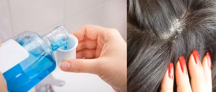 2. Trị gàu: Sau khi gội đầu bằng dầu gội thông thường, bạn hãy tráng lại 1 lần nữa với hỗn hợp nước lã và nước súc miệng rồi ủ khoảng vài phút. Ảnh: www.phunuvagiadinh.vn.