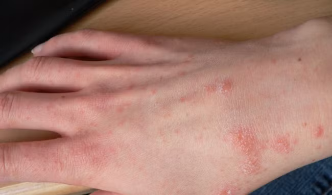 Chữa ghẻ: Lá me, lá sầu đâu, mỗi vị 30-50g nấu nước tắm ngâm ngày 2-3 lần. Ảnh: bacsiviemdacodia.com.