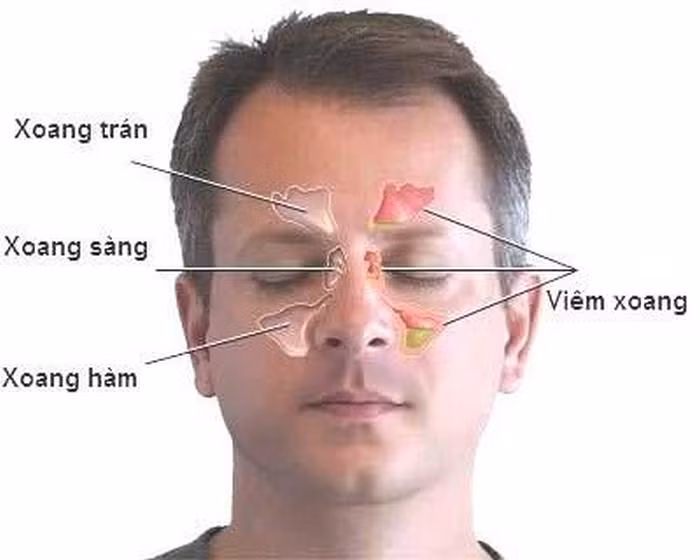 Cà độc dược chữa viêm xoang. Dùng lá cà độc dược phơi cuốn nguyên cả lá lại như điếu thuốc rồi đốt lên dùng phễu đưa lên mũi hít khói hoặc xông vào đường họng. Lúc đầu thì thấy cay, khét khó chịu sau quen dần. Hít và xông ở mức độ chịu được thì thôi, không nên cố hít. Làm như thế trong vài tuần, tùy theo mức độ bệnh ngày hít hoặc xông 1 – 2 lần. Ảnh: Viemxoangmui.