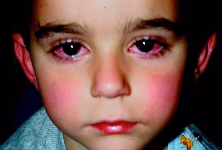 2. Mắt thường hay đỏ ngầu: Có thể do mắt bị nhiễm nấm, nhiễm khuẩn do bạn bị bệnh ho (khi ho dữ dội, vi khuẩn sẽ vô tình xâm hại mắt) hoặc bị lây từ người khác. Là một dấu hiệu của đau mắt đỏ, ra gỉ mắt nhiều, chảy nước mắt, sưng mắt. Cần tới gặp bác sĩ để điều trị ngay. Ảnh: wisemedic.net.