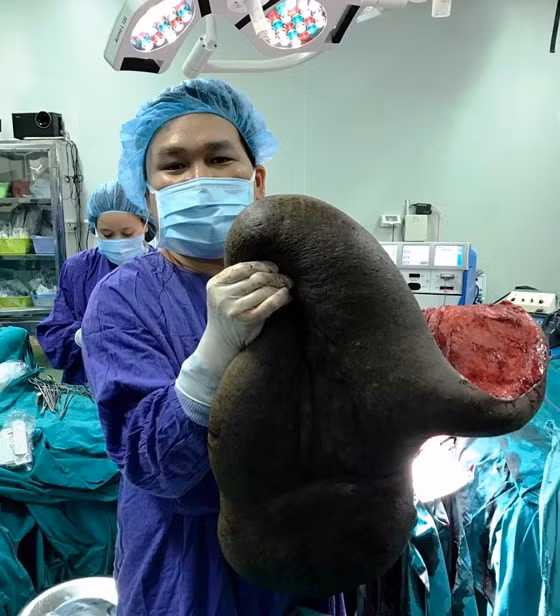 Khối u khổng lồ được các bác sĩ cắt bỏ lấy ra khỏi lưng bệnh nhân.