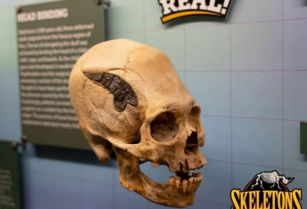 Thứ khiến các nhà khoa học bối rối và tranh luận chính là mảnh kim loại được ghép vào hộp sọ, kéo dài từ thái dương bên phải dần lên hướng đỉnh sọ.