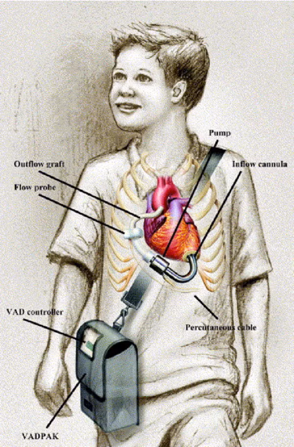 Thiết bị MicroMed - DeBakery VAD được NASA phát minh từ thập niên 1980, nó giúp bệnh nhân sống sót trong lúc họ chờ đợi được cấy ghép tim bằng cách bơm máu truyền đi khắp cơ thể, giảm bớt căng thẳng cho tim.
