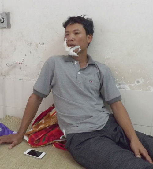 Vụ tai nạn làm 6 công nhân bị thương, trong đó 2 người bị thương nhẹ, 3 công nhân khác bị thương ở phần mềm và 1 công nhân bị gãy xương sườn.