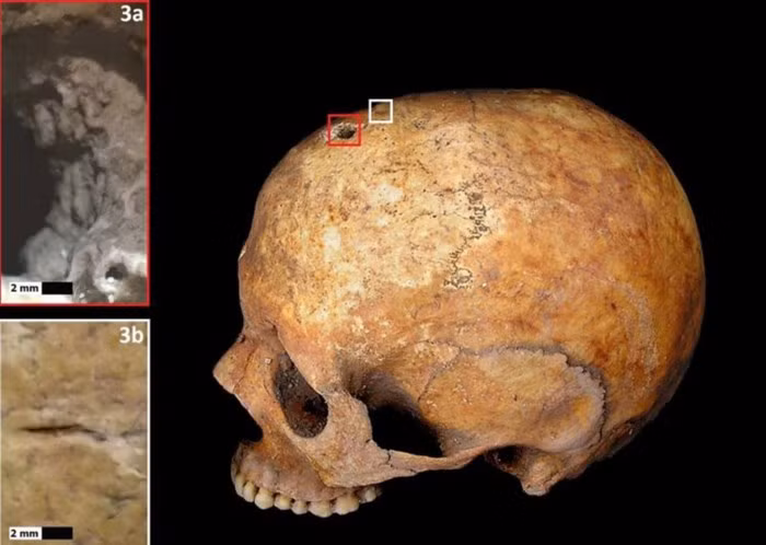 Rất ít bệnh nhân sống sót sau khi trải qua ca phẫu thuật khoan lỗ trên hộp sọ rùng rợn như trên.