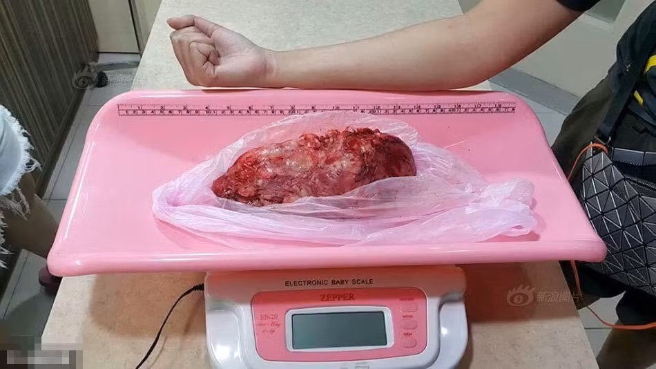 Sau khi bóc tách, người ta cân được trọng lượng khối u là 1kg. (Nguồn Sina)