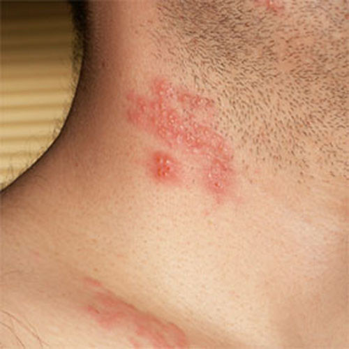 Khi bị zona thần kinh, tốt nhất là bạn điều trị ngay trong vòng 48 giờ kể từ khi phát hiện. Nếu điều trị càng muộn thì nguy cơ biến chứng càng cao.