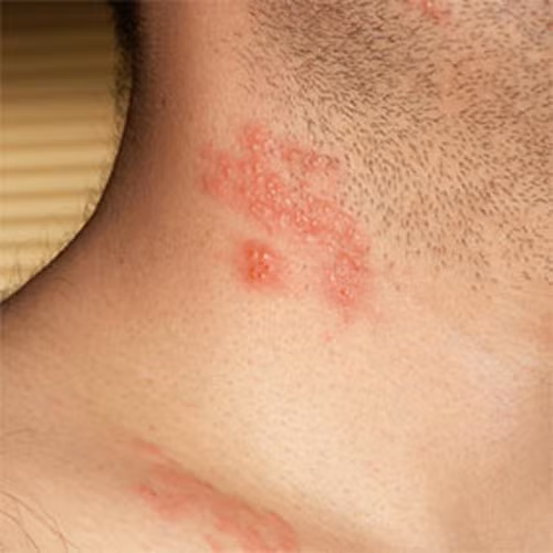 Khi bị zona thần kinh, tốt nhất là bạn điều trị ngay trong vòng 48 giờ kể từ khi phát hiện. Nếu điều trị càng muộn thì nguy cơ biến chứng càng cao.