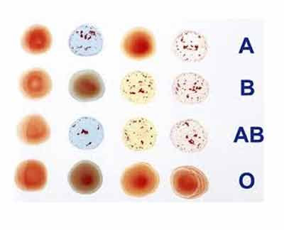 Vấn đề bộ nhớ. Một nghiên cứu gần đây trên 30.000 người ở trường đại học Vermont cho thấy, những người có nhóm máu AB sẽ mắc các bệnh về tư duy và trí nhớ cao hơn 82% so với các nhóm máu khác.