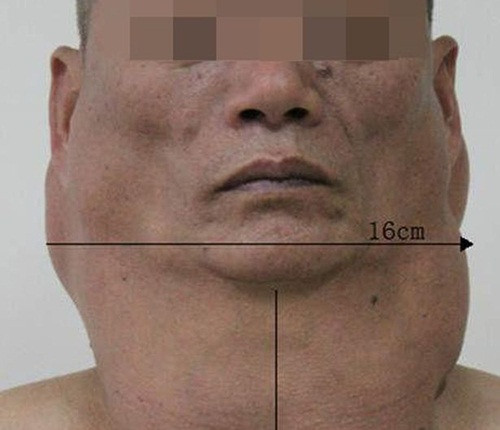 Cổ phình to như lạc đà vì uống rượu suốt 30 năm Co phinh to nhu lac da vi uong ruou suot 30 nam