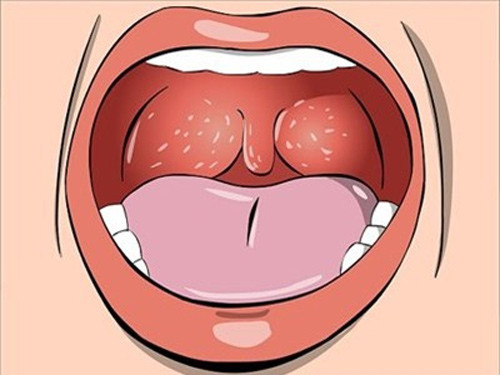 Một số người vì thường xuyên bị sưng tấy lặp đi lặp lại nên đã tiến hành phẫu thuật cắt amiđan.