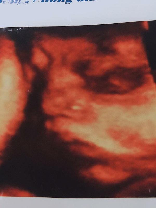 Hình ảnh con anh L. siêu âm trước khi mất. Ảnh gia đình cung cấp.