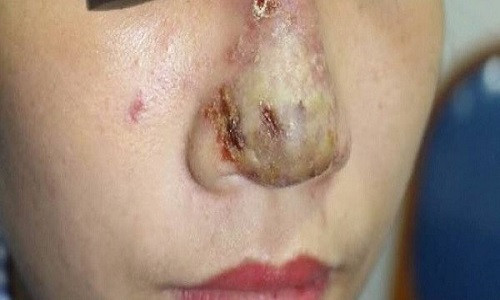 Mũi cô gái bị biến chứng nặng nề sau tiêm filler. Ảnh: BSCC