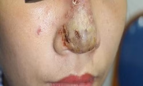 Mũi cô gái bị biến chứng nặng nề sau tiêm filler. Ảnh: BSCC Mũi cô gái bị biến chứng nặng nề sau tiêm filler. Ảnh: BSCC