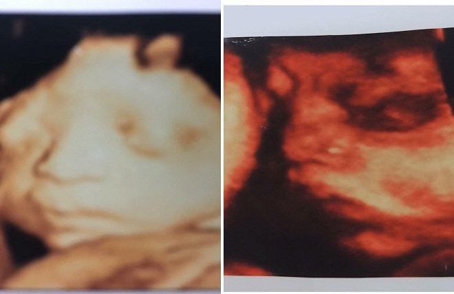 Chồng quẫn trí tự tử vì mất 2 con ở Bắc Giang, bạn thân đi cùng vợ cho biết thai nhi bị chết lưu khoảng 2 tuần trước khi người vợ thông báo mất con