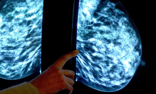 70% phụ nữ bị ung thư vú giai đoạn đầu có thể tránh sử dụng hóa trị. Ảnh: Independent.