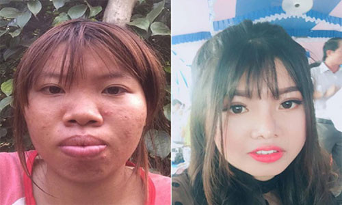 Diện mạo trước khi dao kéo và hiện tại của "Thị Nở tái sinh" Quách Kim Phượng khác nhau "một trời một vực".