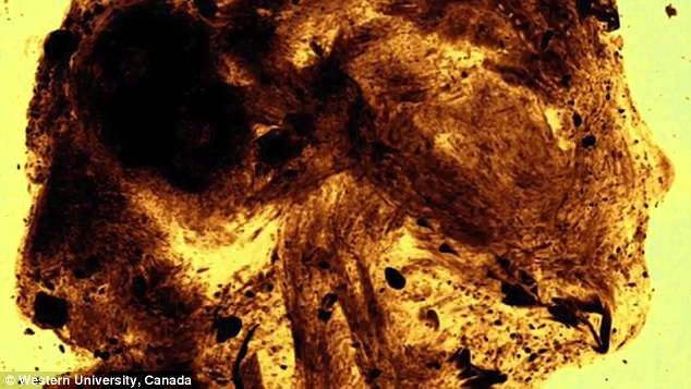 Thi hài bé trai này chết non là trường hợp hiếm gặp vì não và hộp sọ cậu bé đã không thể phát triển. Toàn bộ phần đầu hộp sọ đã không được thành hình. Thêm nữa, các đốt sống của cậu bé đã không khít với nhau và tiểu cốt nhĩ lại nằm phía sau đầu.