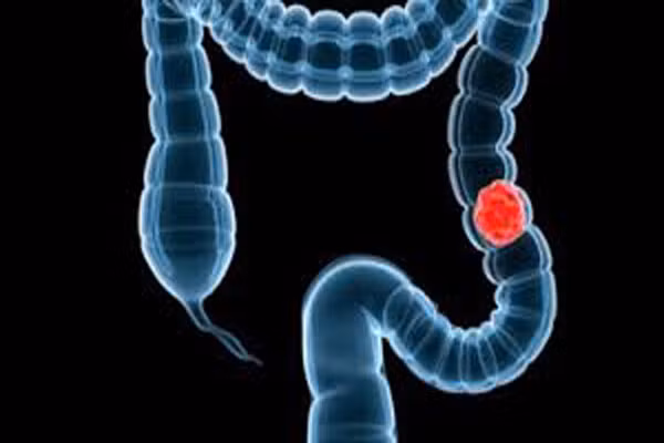 8. Tránh tiếp xúc với các chất gây ung thư. Ví dụ, bức xạ ion hóa mà đến từ các tia gamma, tia UV-năng lượng cao và X-quang có liên quan đến ung thư phổi, da, tuyến giáp, vú và dạ dày, theo Hiệp hội ung thư Mỹ.