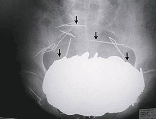 Vào năm 2002, một người đàn ông 62 tuổi đến từ Pháp đã nuốt 350 đồng xu vào bụng để thay đổi chế độ ăn uống. Ngay sau đó, ông đã lập tức được đưa đến bệnh viện. Các bác sỹ đã phát hiện một khối tiền xu nặng 5,5kg, trông hệt như một quả bóng bowling.