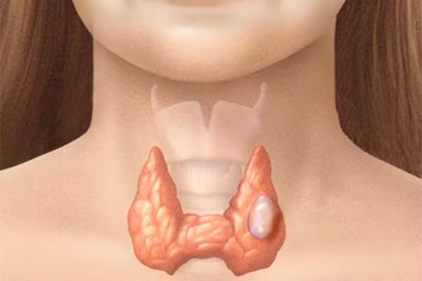 Ung thư tuyến giáp. Hội chứng di truyền làm tăng nguy cơ ung thư tuyến giáp bao gồm ung thư tủy tuyến giáp, tân nội tiết và nhiều bệnh polip adenomatous gia đình. Một số xét nghiệm máu có thể giúp nhận diện những người có nguy cơ cao bị các loại ung thư tuyến giáp có tính di truyền. Những người nào được phát hiện có nguy cao bị ung thư, có thể cần phải cắt bỏ tuyến giáp để phòng ung thư dù là chưa có triệu chứng gì cả.