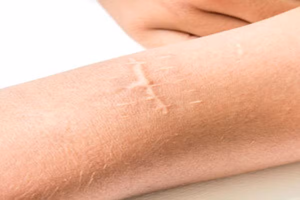 Vết bỏng và sẹo. Những vết sẹo và loét lâu lành có thể phát triển đến ung thư da. Chúng sẽ phát triển thành ung thư biểu mô tế bào vảy do viêm mãn tính hoặc thay đổi thành tế bào ác tính. Vậy nên, nếu như vết thương mãi không liền sẹo thì bạn nên đi kiểm tra bác sỹ.