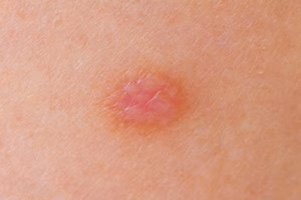 Virus HPV. Hiện có hơn 150 chủng vius HPV, nhiều nhất được biết đến là qua đường tình dục, gây ra ung thư cổ tử cung và những mụn cóc dưới da. Virus này có thể lây lan qua da nếu bạn tiếp xúc với ai đó bị mụn cóc.