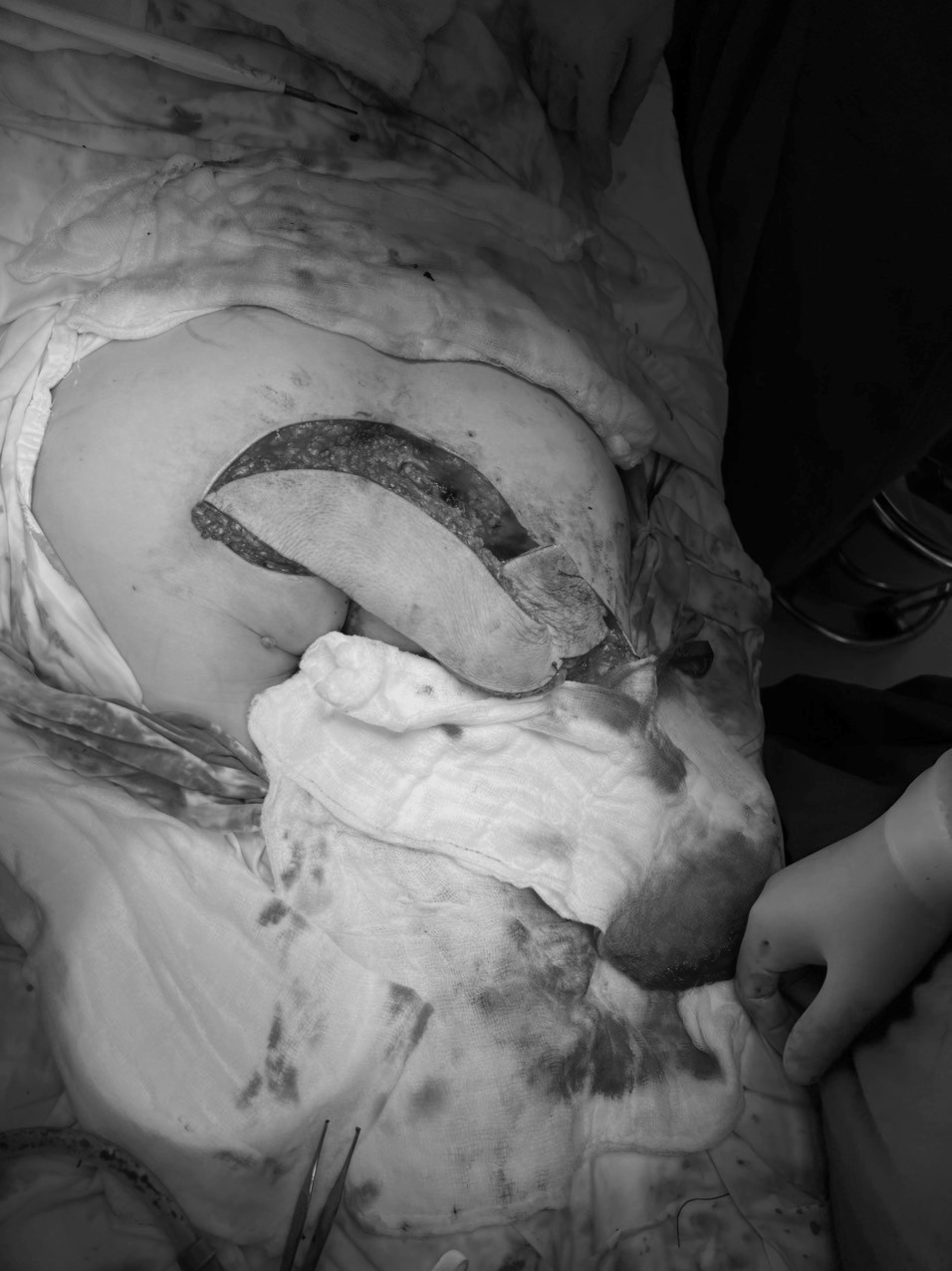 Chuyển vạt da điều trị cho bệnh nhân bị loét cùng cụt 10 năm Chuyen vat da dieu tri cho benh nhan bi loet cung cut 10 nam