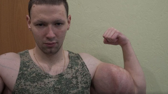 Cả cánh tay của Kirill sưng lên và luôn trong nhiệt độ hơn 38 độ. Kirill cũng bị viêm cơ và rất khó chịu.