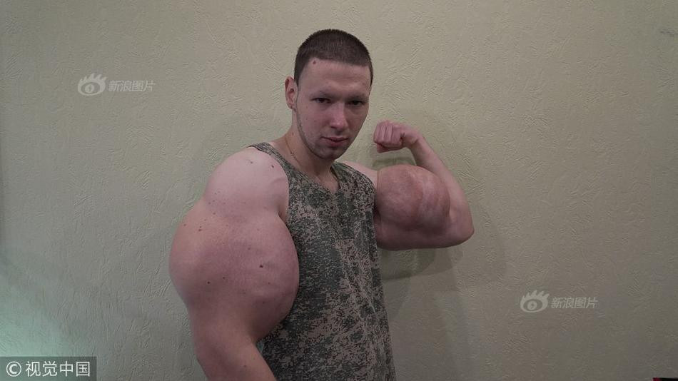 Chàng trai trẻ Kirill Tereshin, 22 tuổi, người Nga, vì muốn có một thân hình lực lưỡng, cơ bắp giống như nhân vật nổi tiếng người khổng lồ xanh Hulk, đã bất chấp rủi ro, nguy hiểm về sức khỏe để tiêm vào bắp tay một loại dầu, khiến bắp tay phình to trông rất đáng sợ.