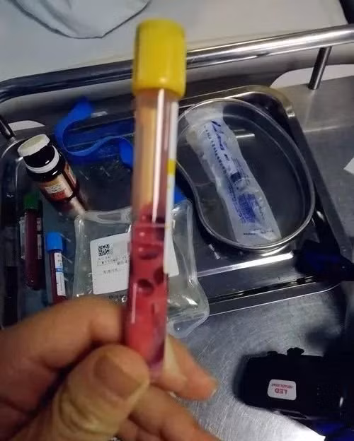 Bac si lay mau benh nhan, ra mau hong ky quai, phat hien kinh di...-Hinh-2