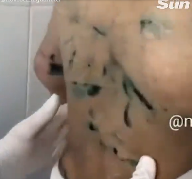 Cuộc điều tra sau đó được tiến hành đã tiết lộ những sự thật gây sốc về cuộc sống của bé gái trong thời gian ở với người cô Ganieva suốt 6 tháng. Ảnh: Vết thương ở lưng bé gái.