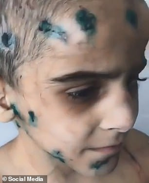 Khi khám cho bệnh nhi, các bác sĩ chẩn đoán phần dưới cánh tay phải của bé gái bị hoại tử, đồng thời phát hiện nhiều vết bỏng, vết cắn và vết dao cắt trên khắp cơ thể Aisha.