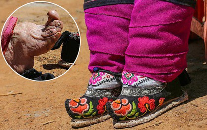 Đôi chân biến dị vì giày gót sen