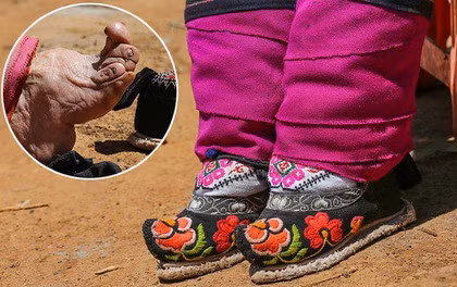 Đôi chân biến dị vì giày gót sen