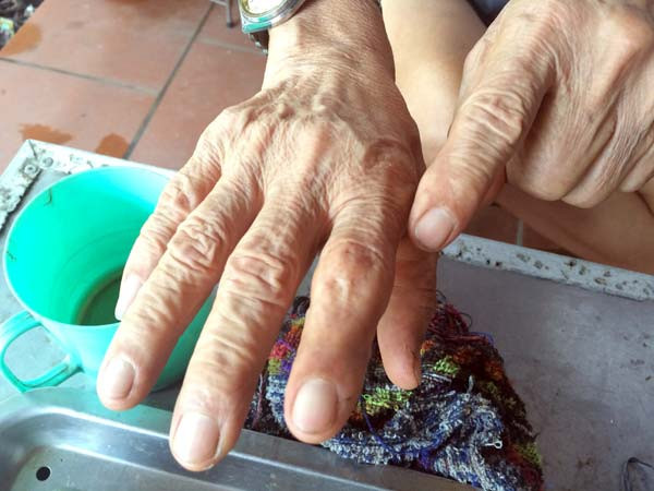 9 lần bị rắn độc cắn đã để lại trên hai bàn tay cụ Pháo nhiều vết sẹo.