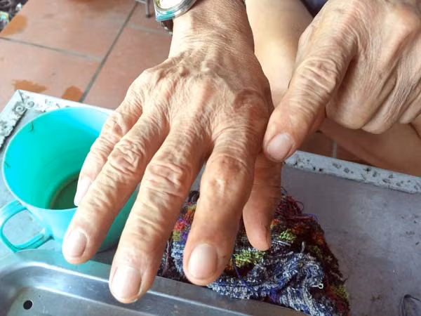 9 lần bị rắn độc cắn đã để lại trên hai bàn tay cụ Pháo nhiều vết sẹo.