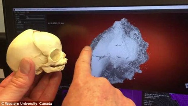 Toàn bộ phần trên của hộp sọ không được hình thành.