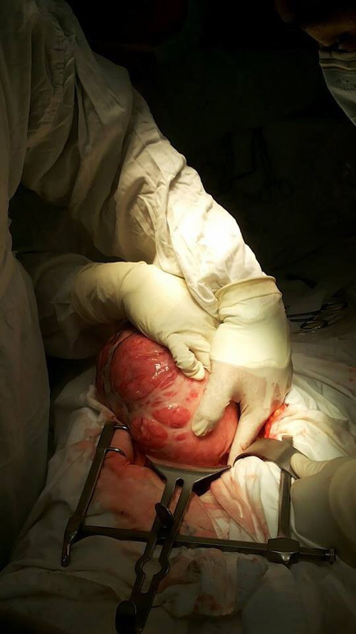 Bé gái bị nghi có thai vì khói u gàn 6kg trong bụng