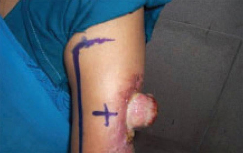 Dau hieu nhan biet ung thu tuyen mo hoi