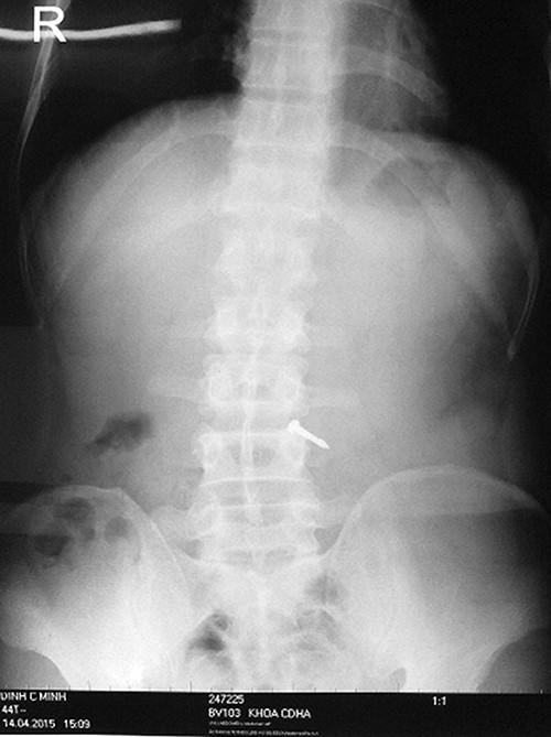 Nuót phải dinh be tong thì thói quen ngạm trong miẹng-Hinh-2