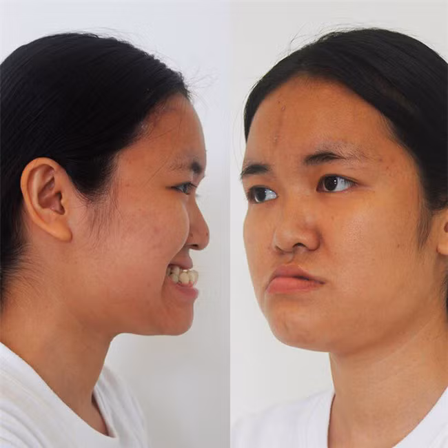 19 năm trời chỉ mong được một ngày sống như người bình thường vì gương mặt sinh ra đã méo mó khó nhìn, Lê Huyền Trang (quê Thanh Hóa, sinh viên trường Đại học Thương mại Hà Nội) từng trượt dài trong mặc cảm.