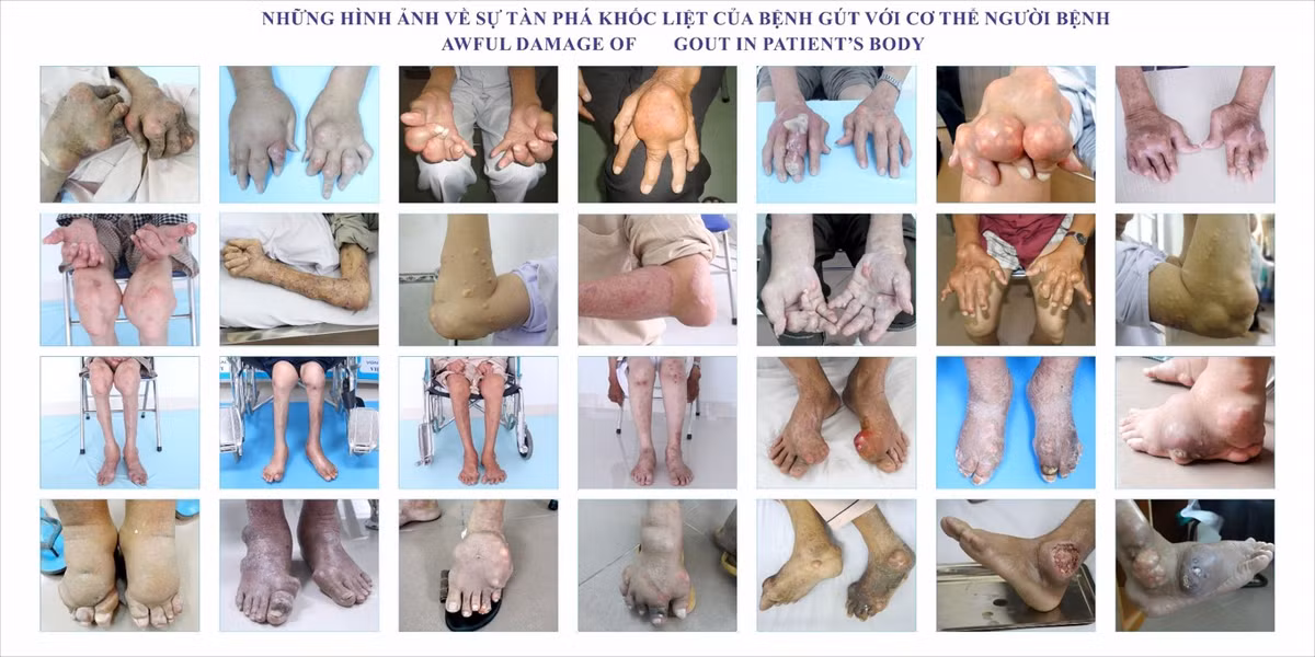 Benh gut kem dai thao duong, xo gan co truong, suy than man co the duoc quan ly tot