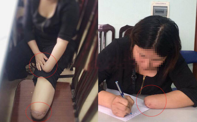 Qua điều tra, Công an phát hiện nhiều dấu hiệu nghi vấn. Theo kết luận giám định thương tật, N. bị tổn hại 79% sức khỏe. Tuy nhiên, thương tích ở tay và chân do vật sắc nhọn gây ra. Đặc biệt, cơ quan điều tra phát hiện, trước đó hơn 1 tháng, N. mua liên tiếp 3 gói bảo hiểm thân thể của 2 công ty bảo hiểm nhân thọ. Theo hợp đồng, nếu bị thương tật vĩnh viễn do tai nạn giao thông, cô ta có thể được thanh toán tổng số tiền khoảng 3,5 tỷ đồng. Do mục đích trục lợi bảo hiểm chưa hoàn thành, phía bảo hiểm chưa bồi thường nên N. không bị khởi tố. Tuy nhiên, những thương tật trọn đời là cái giá quá đắt cho hành vi liều lĩnh, bất chấp tính mạng để tìm cách trục lợi bảo hiểm.