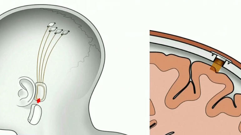 Để cấy chip vào hộp sọ người, Neuralink sẽ dùng đến một cỗ máy tinh vi là một robot. Tỷ phú Elon Musk nói rằng, việc kết nối chip với bộ não mất hàng giờ và chỉ để lại một vết sẹo nhỏ.