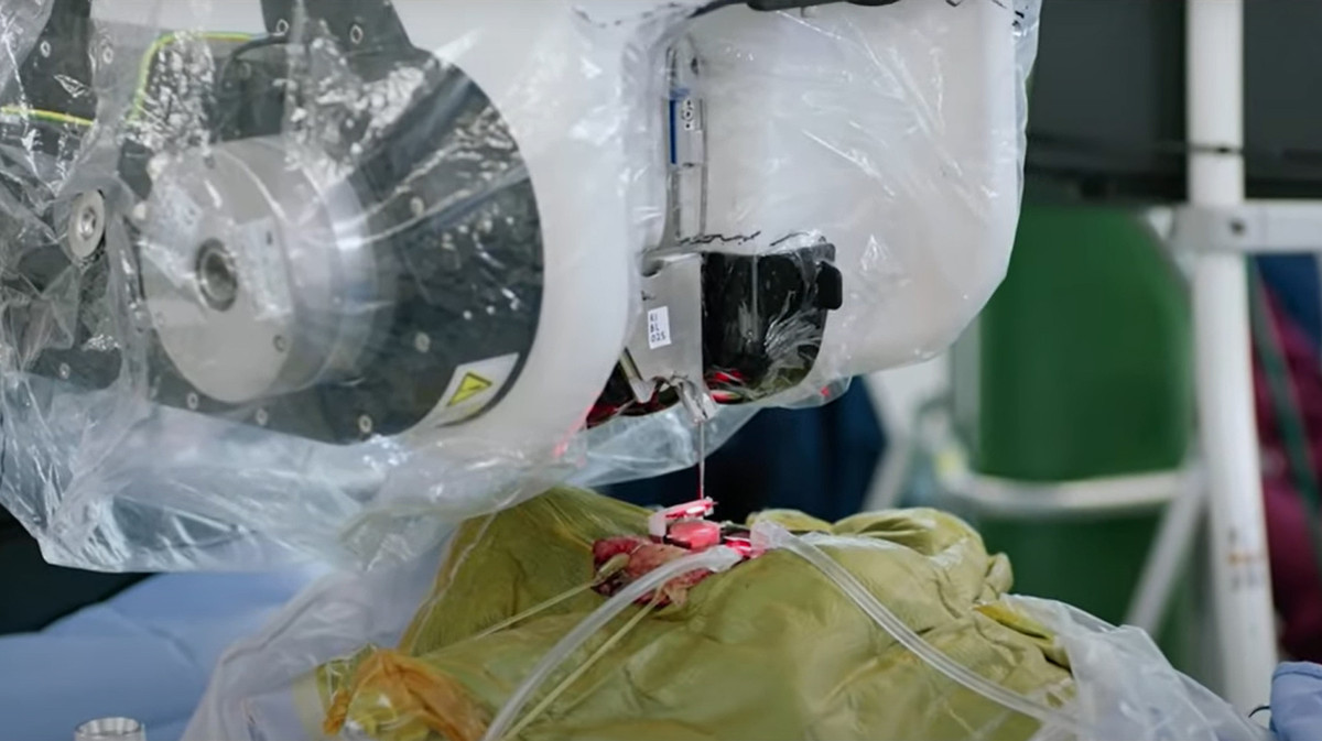 Cỗ máy cấy chip vào não người này có thể kết nối chip một cách chính xác, không tổn thương não hay các mạch máu. Sau quá trình phẫu thuật vài giờ chỉ để lại một vết sẹo nhỏ.