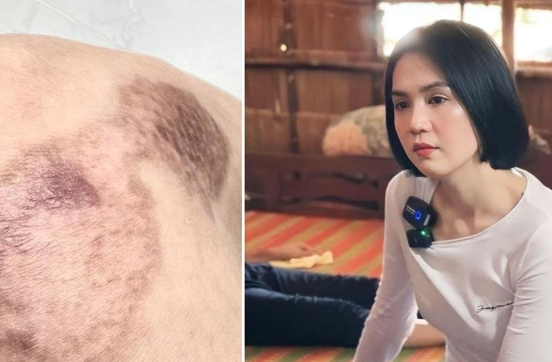 Mới đây, Ngọc Trinh chia sẻ hình ảnh vết sẹo trên chân do tai nạn mô tô. Cô trải lòng: “Ngày trước bị 1 vết sẹo nhỏ, đã giãy nảy lên, coi đó là một chuyện không chấp nhận được, lo lắng ngày đêm. Còn bây giờ, sau khi trải qua nhiều chuyện lớn hơn, cảm thấy những vết sẹo này chỉ là một chuyện nhỏ, như những vết điểm nhẹ thoáng qua trong đời. Coi như đó là một chuyện đáng nhớ trong cuộc đời. Suy ra mỗi câu chuyện, mỗi sự việc đều có nhiều cách nhìn khác nhau, quan trọng mình đón nhận nó như thế nào”. Ảnh: FBNV.